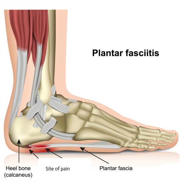 What is my plantar fascia and why is it painful?